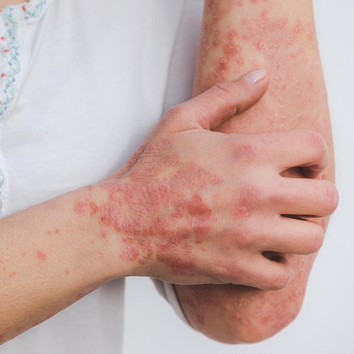 person with psoriasis