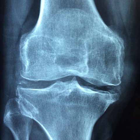 knee joint with arthritis